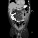Mesenteric abscess, gastroenteroanastomosis, end-to-side, small-bowel stenosis: CT - Computed tomography